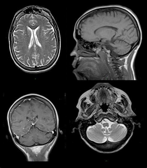 Mri Of The Brain With Contrast Showing Minimal Scattered Nonspecific