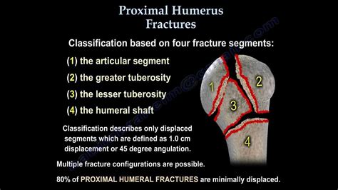 Pin By Sarah Liyana On Humerus Fracture In 2021 Humerus Fracture