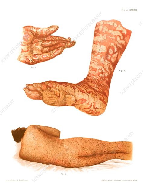 Dermatitis And Pityriasis Illustration Stock Image C0308471