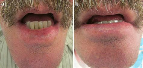 Grade Iv Actinic Cheilitis In The Lower Lip A Showing Partial