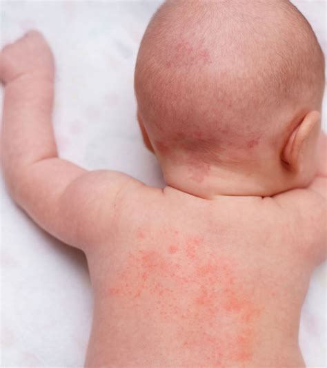 Baby Heat Rash Types Symptoms And Treatment Momjunction