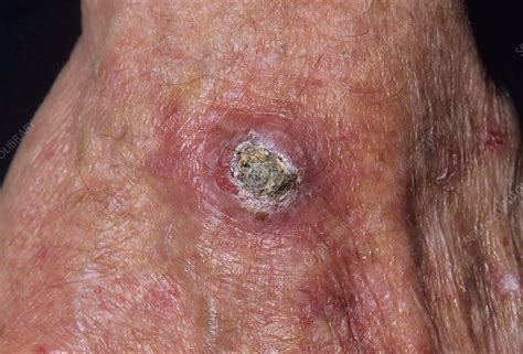 Skin Cancer Nodules