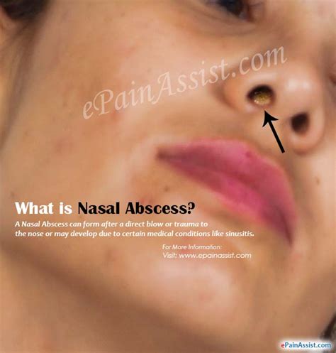 What Is Nasal Abscess How Is It Treated