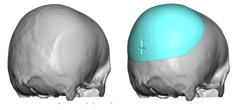 Custom Skull Implant Design For Male Flat Back Of The Head Dr Barry