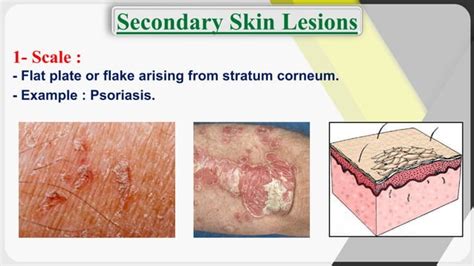 Dermatology Terminology Of Skin Lesions