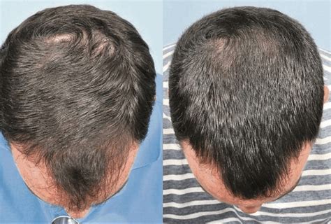 Tips To Stop Hair Loss With Regaine News Dentagama