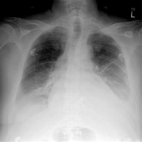 Chest X Ray Of The Patient Showing Bilateral Pleural Effusion Images