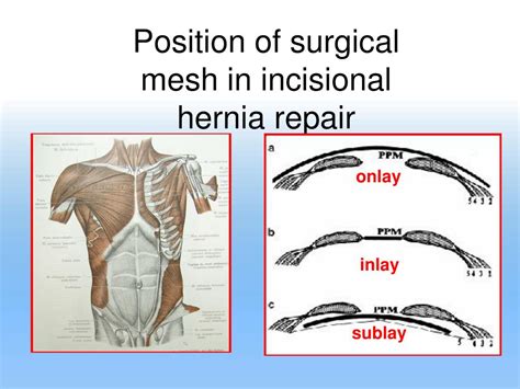 ppt abdominal hernias and surgical meshes powerpoint presentation sexiz pix