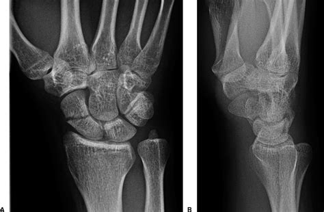Diagnosis Of Scaphoid Fracture Displacement Journal Of Hand Surgery