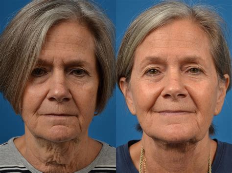 Patient 122406467 Profile Neck Lift Before And After Photos Clevens