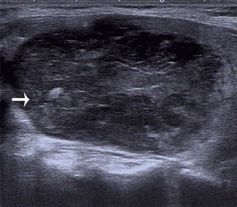 Ultrasound For The Diagnosis Of Primary Thyroid Lymphoma
