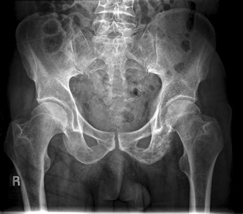 Neck Of Femur Fractures Cases Wikiradiography