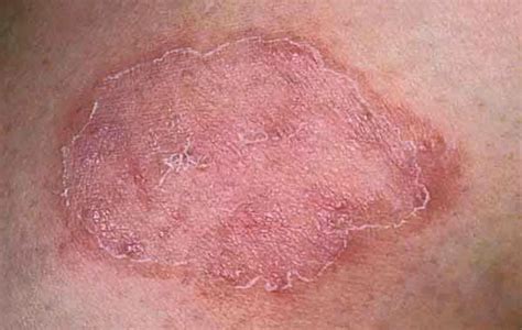 Rain Rot Ringworm Lumps And Bumps Skin Disease Refresher Kienitvc