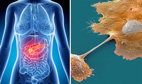 One of those nightmare cancers that tend to progress insidiously and unrecognisably until finally detected at a late and incurable stage. Pancreatic cancer 'will become one of top four killer ...