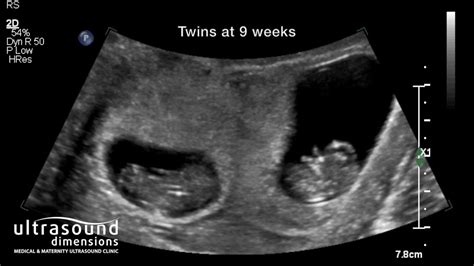 8 Week Ultrasound Fraternal Twins