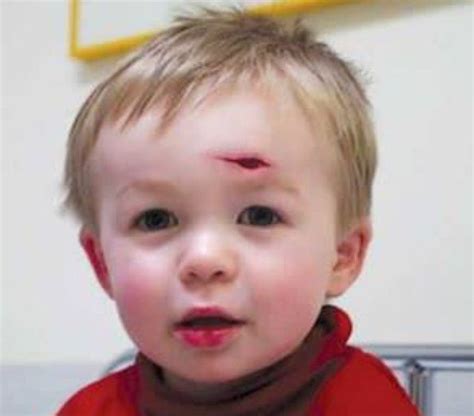 Young Child With 3cm Facial Laceration Closure Method Medizzy