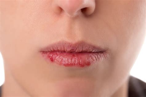 What Does It Mean If You Have A Black Spot On Your Lip Beauty Mag