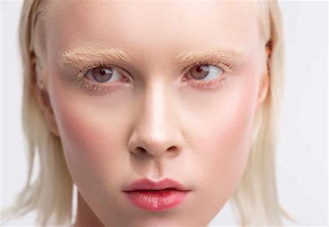 Ocular Albinism Symptoms And Treatment Área Oftalmológica