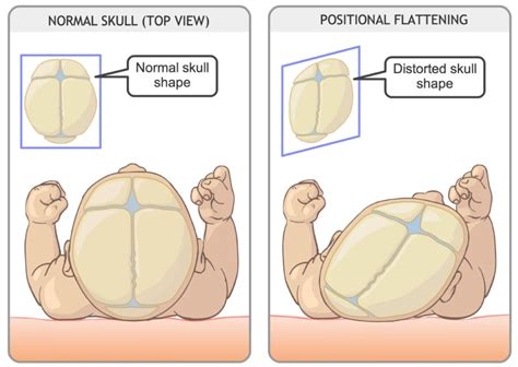 Flattened Head Syndrome Or Positional Plagiocephaly