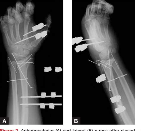 Figure 1 From Ulnar Nerve Palsy Following Closed Radiocarpal Fracture