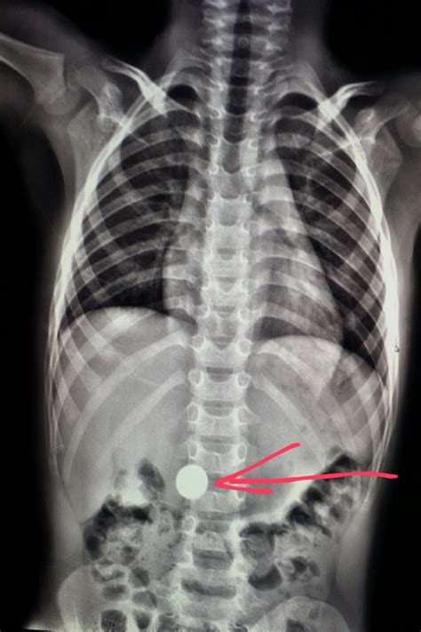 Xray Of A Child Shows A Swallowed Coin In The Stomach Radiology