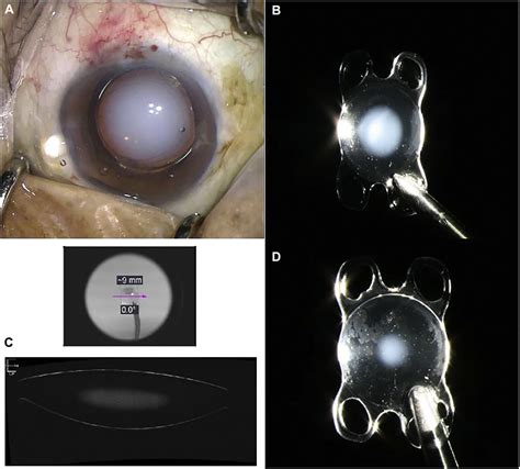 Time Course Of Acute Reversible Clouding Of The Hydrophilic Intraocular
