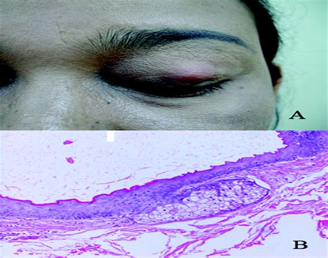 Steatocystoma Simplex Of The Eyelid Ophthalmic Plastic