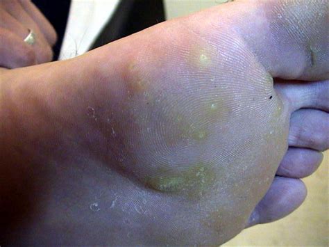 Viral Infections Warts Picture Hellenic Dermatological Atlas Over