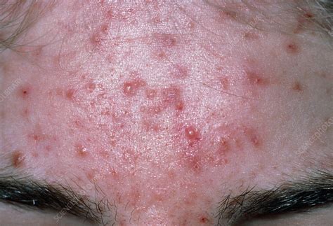 Acne Vulgaris On Forehead Stock Image M1080333 Science Photo Library