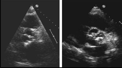 Examples Of Aortic Valve Sclerosis Left Panel Patient With Minimal