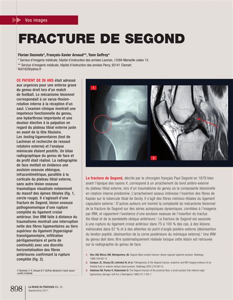 PDF Segond Fracture