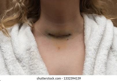 114 Removal Thyroid Gland Images Stock Photos Vectors Shutterstock