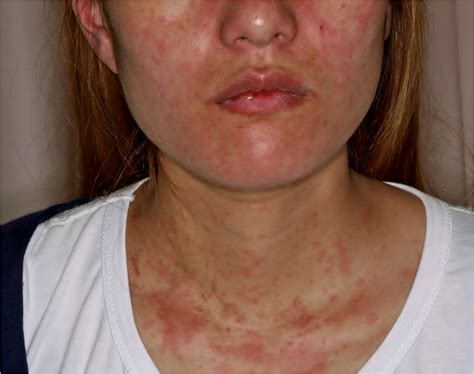 Picture Of The Patient Showing Salmon Colored Rash On Her Face And