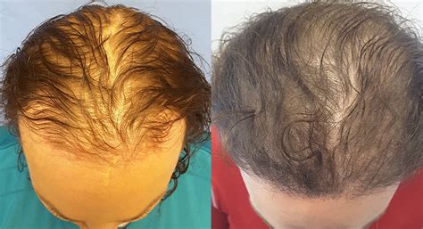 What kind of hair loss issues do transgender people face? Female Hair Transplant - Male to Female Transgender ...