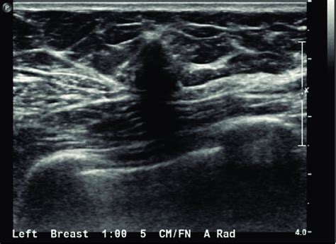 Posterior Acoustic Shadowing Breast Ultrasound