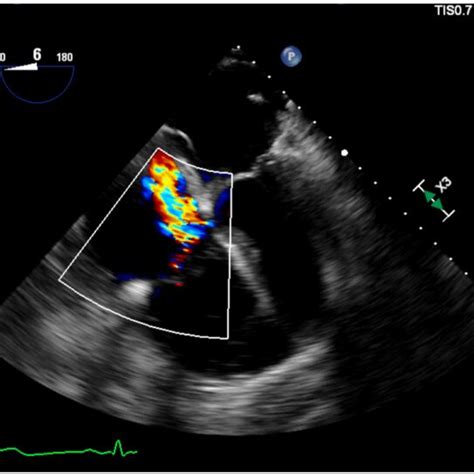 Midesophageal Right Ventricular Inflow Outflow Color Doppler Tee View