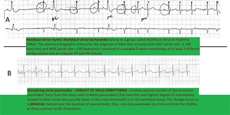 Maybe you would like to learn more about one of these? Icd Vs Pacemaker - Single Vs Dual Chamber Icd - prikaztn