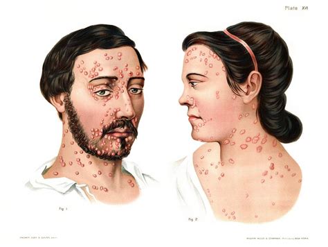 Secondary Syphilis Rash Photograph By Us National Library Of Medicine Science Photo Library