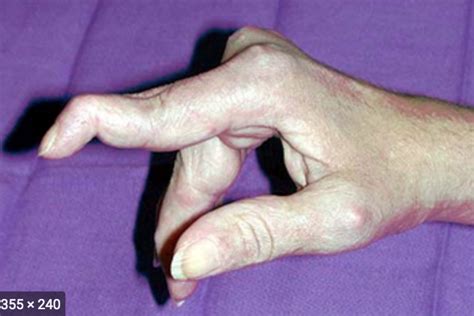 Swan Neck Deformity Hand Orthobullets