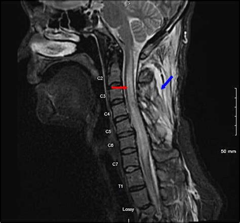 Image 1 Mri Cervical Spine Showing Diffuse Cervical Spinal Cord Edema