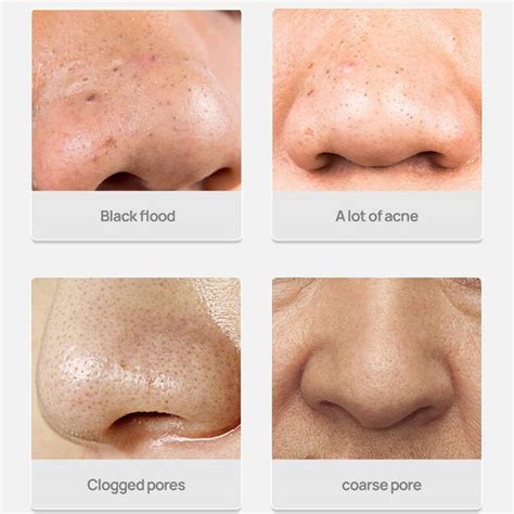 Nose Blackheads Causes Prevention And Treatment Options