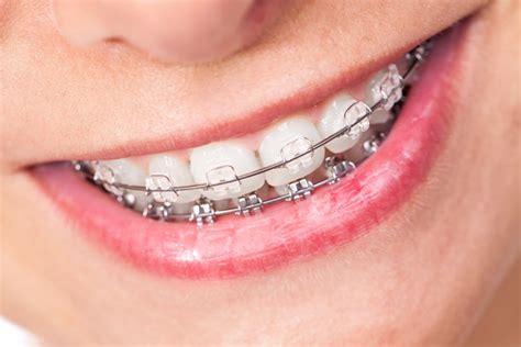 Make The Most Of Your Mouth With Adult Braces