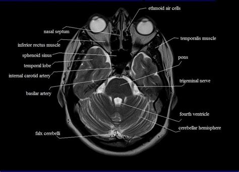 Mri Anatomy Brain Axial Image 8 With Images Brain Anatomy Mri Mri