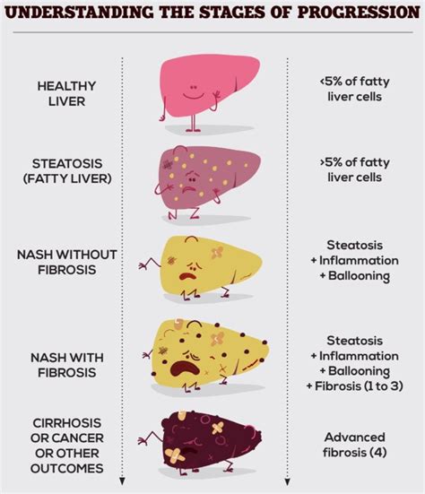 Nash Liver Disease Stages