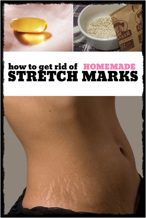How To Get Rid Of Stretch Marks Homemade World Of Fashion
