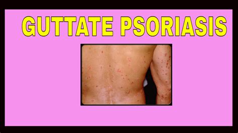 Guttate Psoriasis Symptoms Treatments Causes