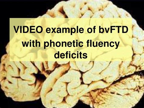 PPT - Frontotemporal Dementia (FTD) PowerPoint Presentation, free ...