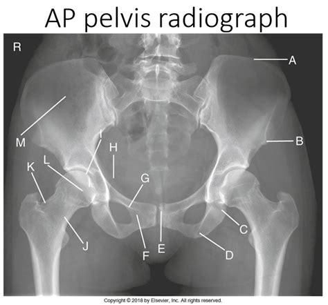 Ap Pelvis Radiograph Diagram Diagram Quizlet
