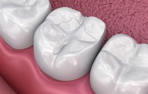 The Ultimate Guide To Cavities Prevention And Treatment