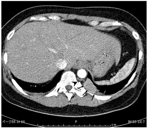 Preoperative Chest Computed Tomography Ct Scan Demonstrated A